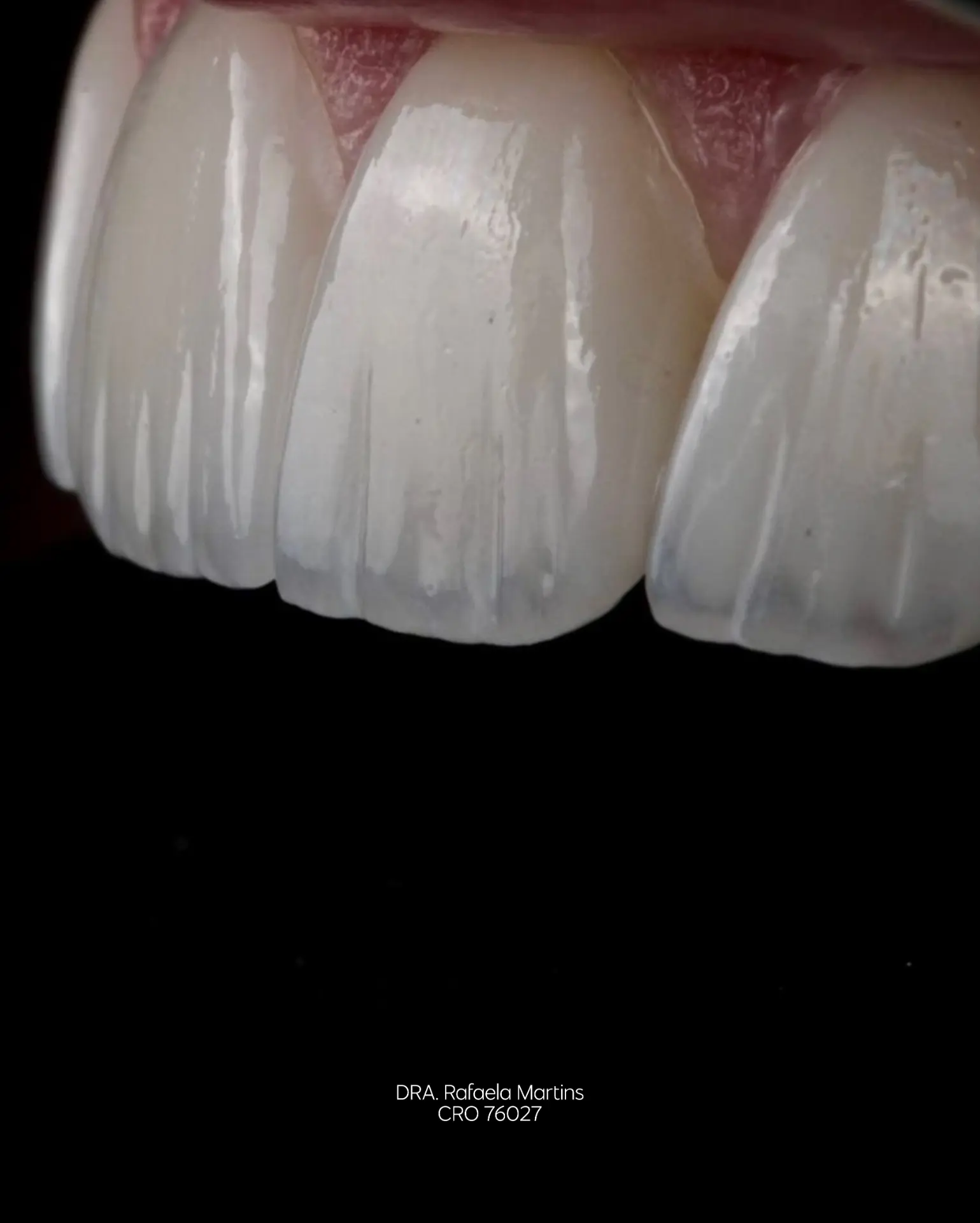 Macro clínico de lentes cerâmicas em dentes anteriores